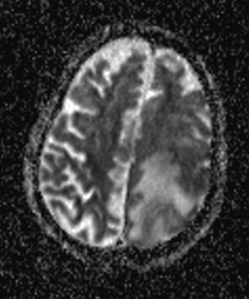 File:Brain abscess with dual rim sign (Radiopaedia 87566-103938 Axial ADC 15).jpg