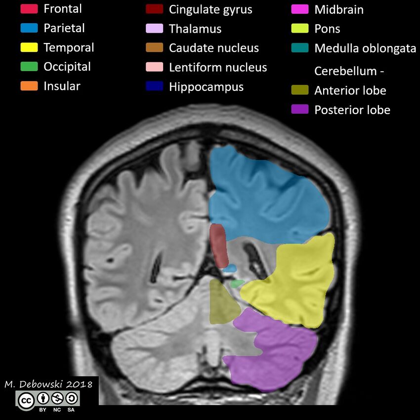 Brain lobes - annotated MRI (Radiopaedia 61691-69700 Coronal 52).JPG