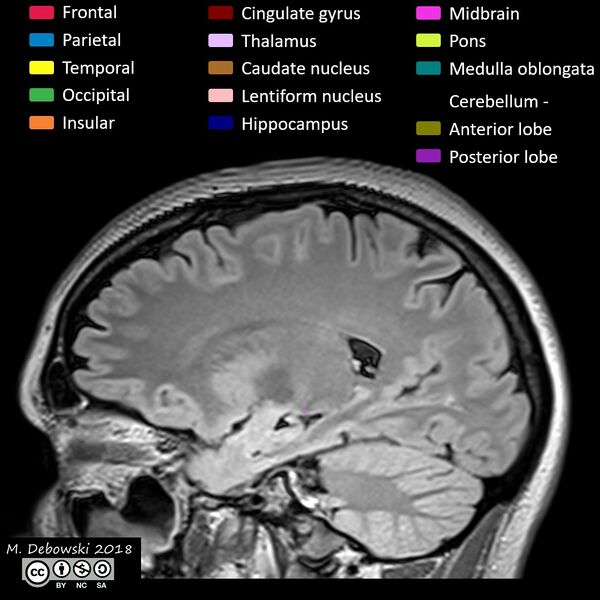 File:Brain lobes - annotated MRI (Radiopaedia 61691-69700 Sagittal 27).JPG