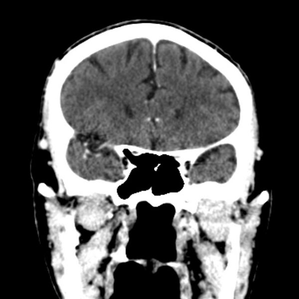 File:Brain metastases from lung cancer (Radiopaedia 27849-28092 Coronal C+ delayed 22).jpg