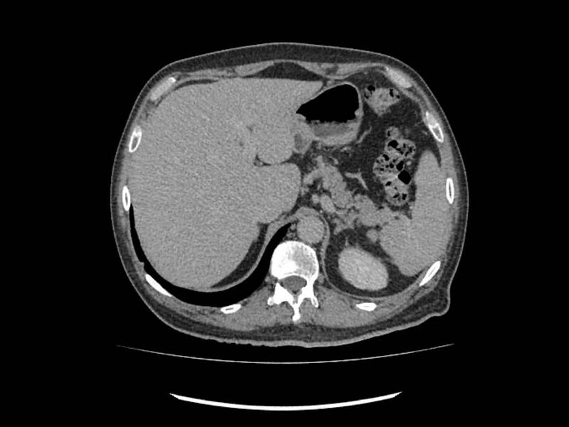 File:Brain metastases from renal cell carcinoma (Radiopaedia 42222-45328 Axial C+ delayed 8).jpg