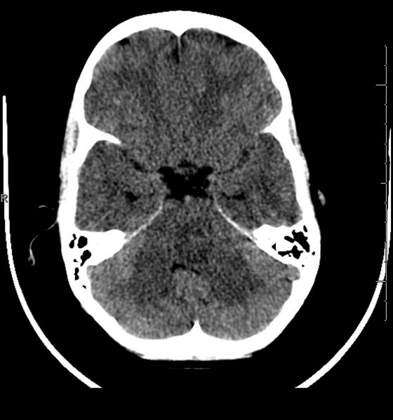 File:Brainstem glioma (Radiopaedia 6524-7838 Axial non-contrast 1).jpg