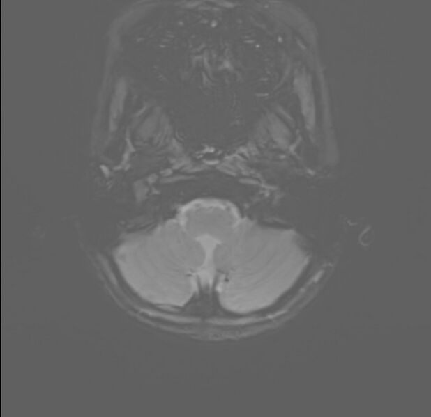 File:Brainstem glioma (Radiopaedia 70548-80674 Axial SWI 1).jpg