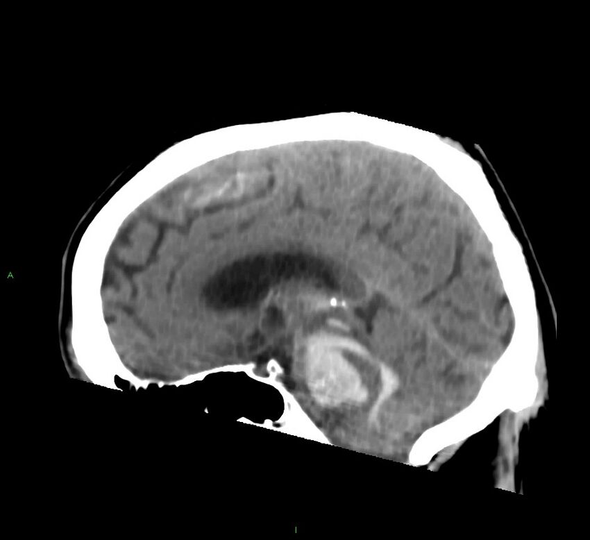 Brainstem hemorrhage (Radiopaedia 58794-66028 C 27).jpg