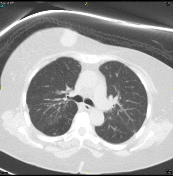 File:Breast primary with lung and bone metastases (Radiopaedia 40620-43228 Axial lung window 20).jpg