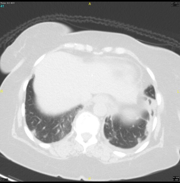 File:Breast primary with lung and bone metastases (Radiopaedia 40620-43228 Axial lung window 41).jpg