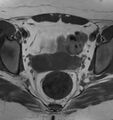 Broad ligament leiomyoma (Radiopaedia 81634-95516 Axial T1 15).jpg