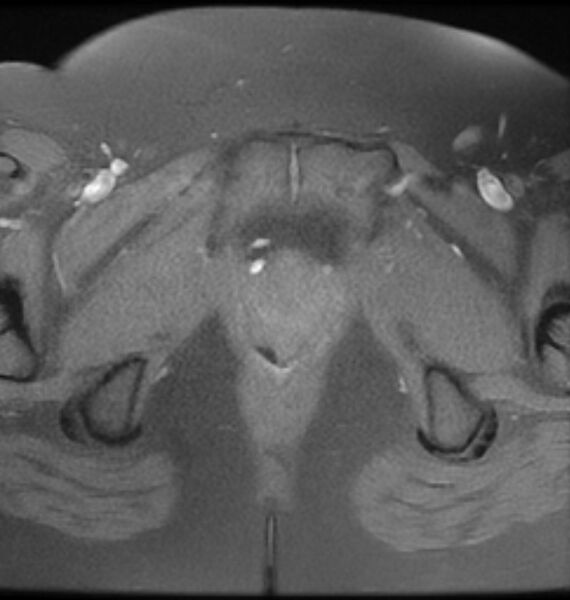 File:Broad ligament leiomyoma (Radiopaedia 81634-95516 Axial T1 fat sat 25).jpg