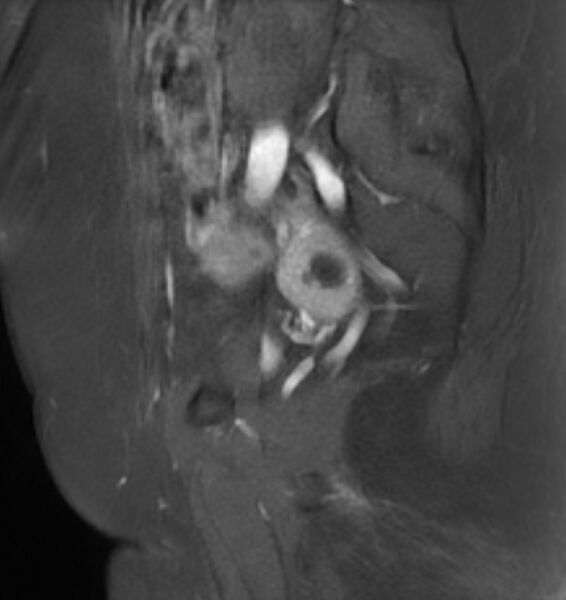 File:Broad ligament leiomyoma (Radiopaedia 81634-95516 G 8).jpg