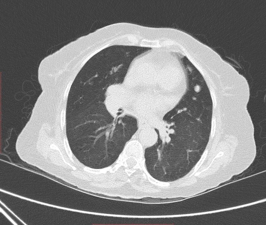 Bronchiectasis (Radiopaedia 72693-83293 Axial lung window 70).jpg