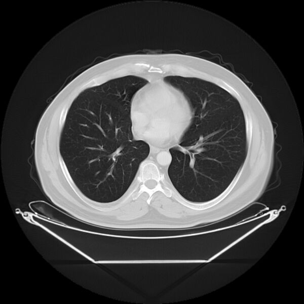 File:Bronchogenic carcinoma with upper lobe collapse (Radiopaedia 29297-29726 Axial lung window 21).jpg