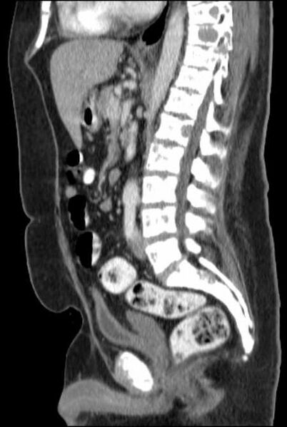 File:Brown tumors compressing the spinal cord (Radiopaedia 68442-77988 F 30).jpg