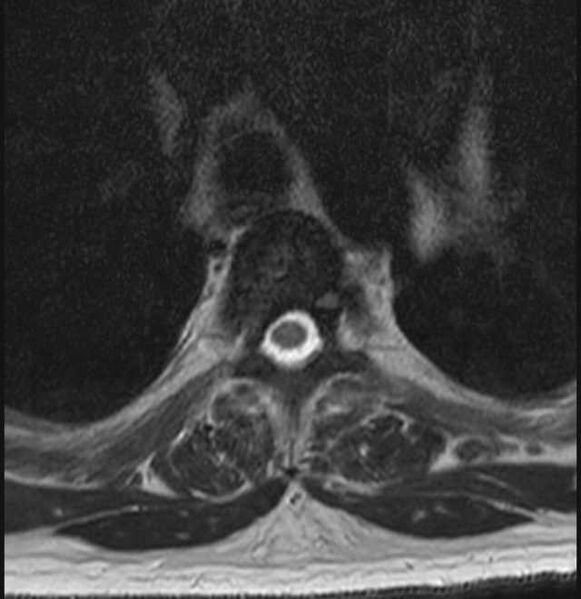 File:Brown tumors compressing the spinal cord (Radiopaedia 68442-78030 A 40).jpg