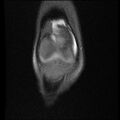 Bucket handle tear - lateral meniscus (Radiopaedia 72124-82634 Coronal PD fat sat 3).jpg