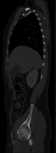 File:Burst fracture (Radiopaedia 83168-97542 Sagittal bone window 44).jpg