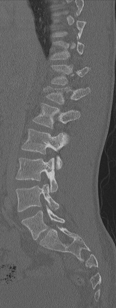 File:Burst fracture - T12 with conus compression (Radiopaedia 56825-63647 Sagittal bone window 53).png