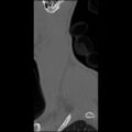 C5 facet fracture (Radiopaedia 58374-65499 Sagittal bone window 66).jpg