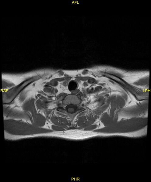 File:C5 nerve sheath tumor (Radiopaedia 85777-101596 Axial T1 24).jpg