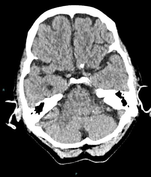 File:Calcified cerebral emboli from left ventricular thrombus (Radiopaedia 84420-99758 Axial non-contrast 69).jpg