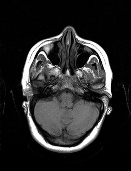 File:Calcified cerebral hydatid cyst (Radiopaedia 65603-74699 Axial T1 5).jpg
