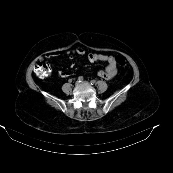 File:Calcified hydatid cyst (Radiopaedia 62000-70085 Axial non-contrast 74).jpg