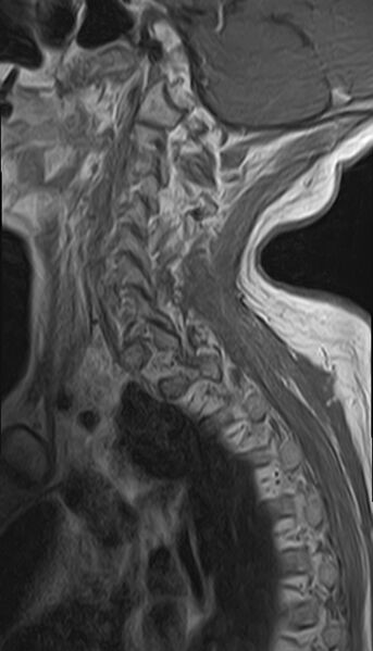 File:Calcified meningioma - cervical canal (Radiopaedia 70136-82468 Sagittal 3).jpg