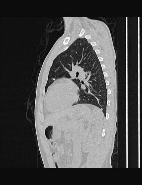 File:Calcifying pulmonary metastases (Radiopaedia 33359-34396 Sagittal lung window 23).jpg