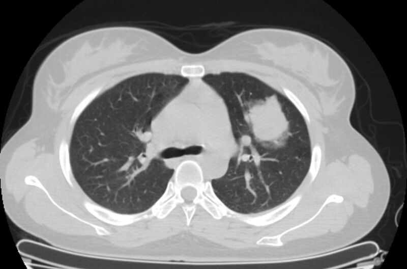 File:Cannonball metastases - uterine choriocarcinoma (Radiopaedia 70137-80173 Axial lung window 28).jpg