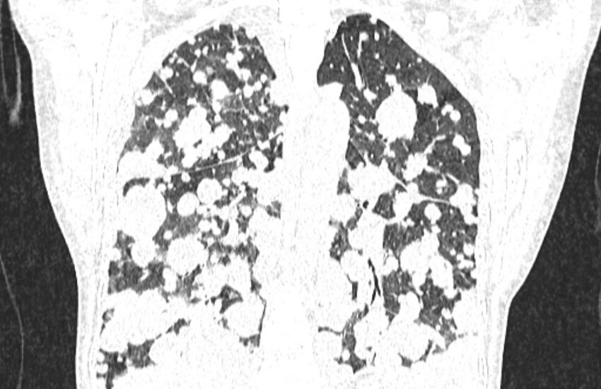 Cannonball metastases from breast cancer (Radiopaedia 91024-108569 Coronal lung window 98).jpg