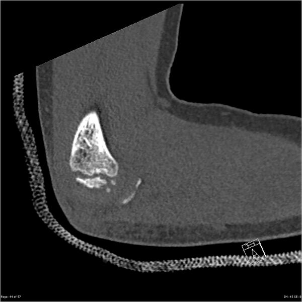 File:Capitellum fracture (Radiopaedia 23352-23426 Sagittal bone window 44).jpg