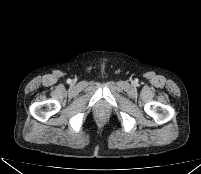 File:Carcinoid tumor with hepatic metastases (Radiopaedia 22651-22670 C 80).jpg