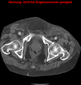 Cardiac perforation following transcatheter aortic valve implantation (Radiopaedia 23714-23863 B 9).png