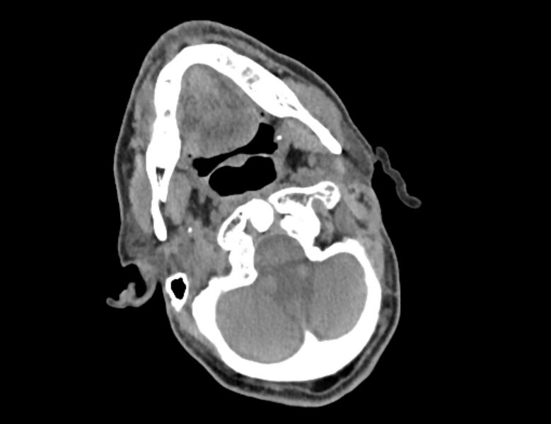 File:Carotid artery pseudoaneurysm (Radiopaedia 84030-99259 Axial non-contrast 2).jpg
