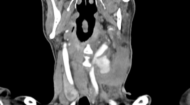 File:Carotid artery pseudoaneurysm (Radiopaedia 84030-99259 D 44).jpg