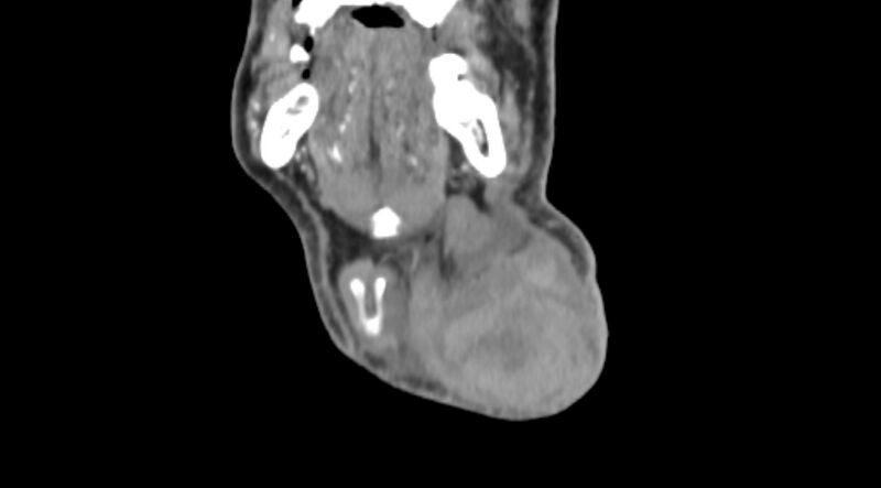 File:Carotid artery pseudoaneurysm (Radiopaedia 84030-99259 D 9).jpg