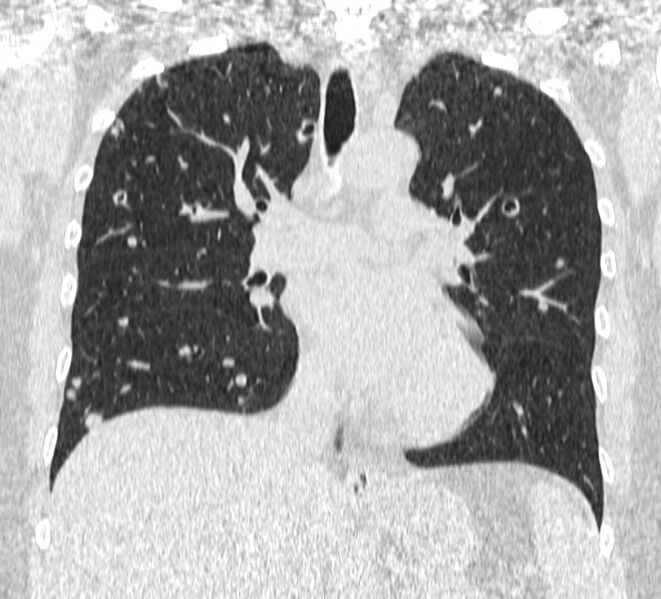 File:Cavitating pulmonary metastases (Radiopaedia 17796-17555 Coronal lung window 12).jpg