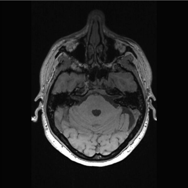 File:Central base of skull meningioma (Radiopaedia 53531-59549 Axial T1 6).jpg