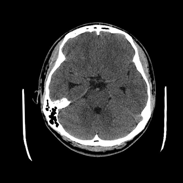 File:Central neurocytoma (Radiopaedia 79320-92379 Axial non-contrast 17).jpg
