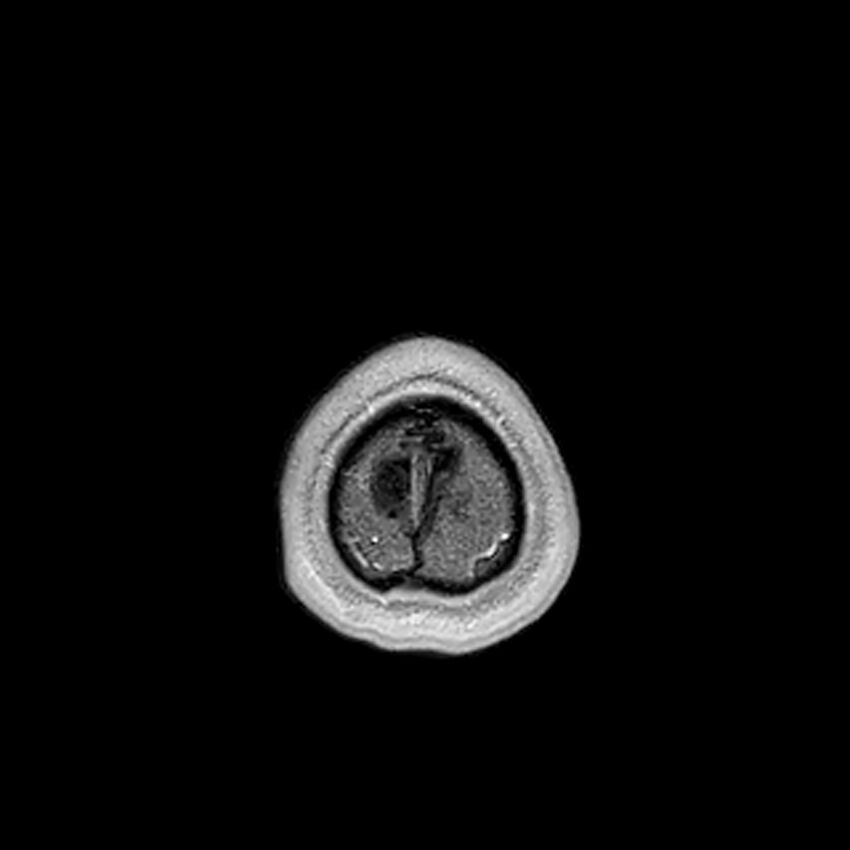 Central neurocytoma (Radiopaedia 79320-92380 Axial T1 C+ 226).jpg