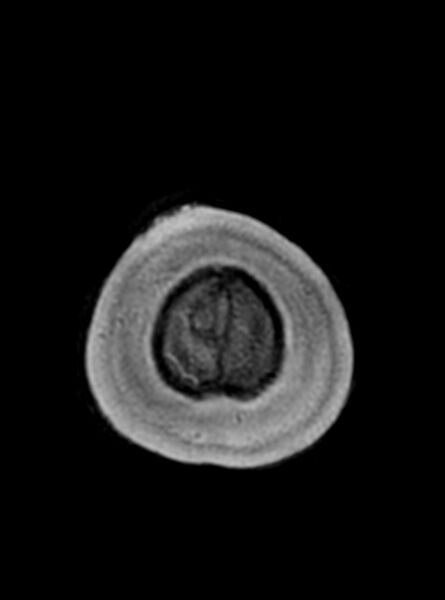 File:Central neurocytoma (Radiopaedia 79320-92381 Axial T1 41).jpg