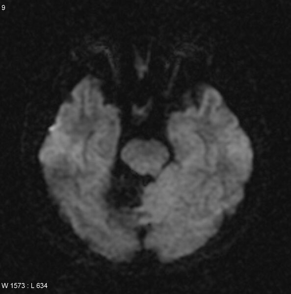 File:Cerebellar arteriovenous malformation (Radiopaedia 5220-6988 Axial DWI 1).jpg