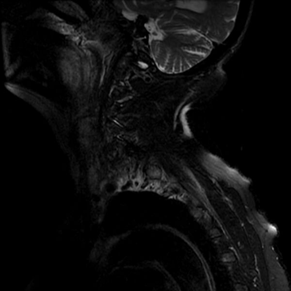 File:Cerebellar ataxia with neuropathy and vestibular areflexia syndrome (CANVAS) (Radiopaedia 74283-85159 Sagittal T2 fat sat 12).jpg