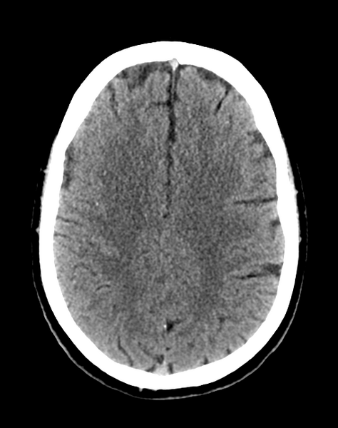 File:Cerebellar infarct due to vertebral artery dissection with posterior fossa decompression (Radiopaedia 82779-97033 Axial non-contrast 25).png
