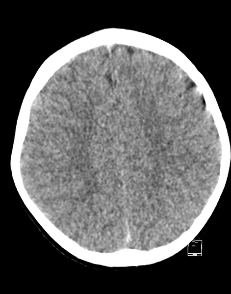 File:Cerebellar stroke (Radiopaedia 32202-33149 Axial non-contrast 20).png