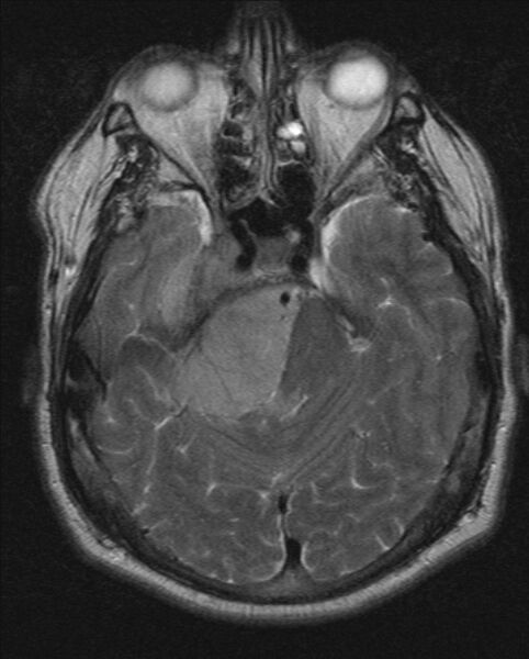File:Cerebellopontine angle meningioma (Radiopaedia 24459-24764 Axial T2 7).jpg