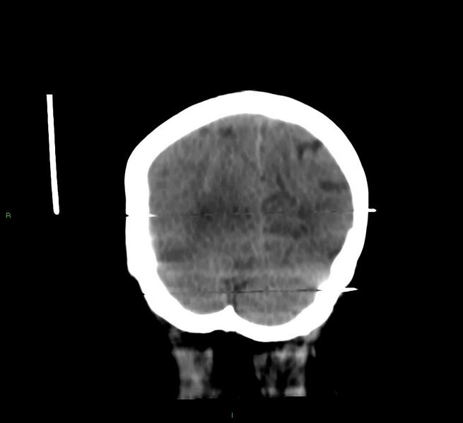 File:Cerebral amyloid angiopathy-associated lobar intracerebral hemorrhage (Radiopaedia 58377-65514 Coronal non-contrast 14).jpg