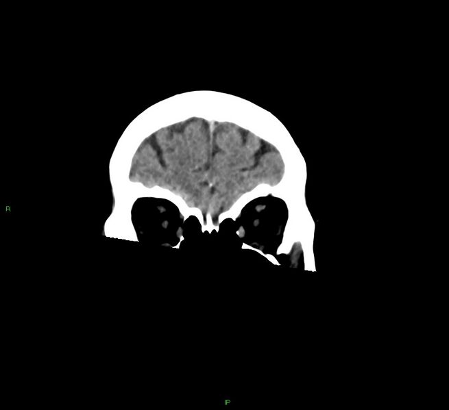 File:Cerebral amyloid angiopathy-associated lobar intracerebral hemorrhage (Radiopaedia 58378-65516 Coronal non-contrast 51).jpg