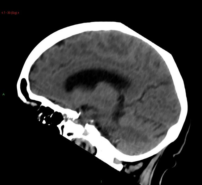 File:Cerebral amyloid angiopathy-associated lobar intracerebral hemorrhage (Radiopaedia 58378-65518 C 30).jpg