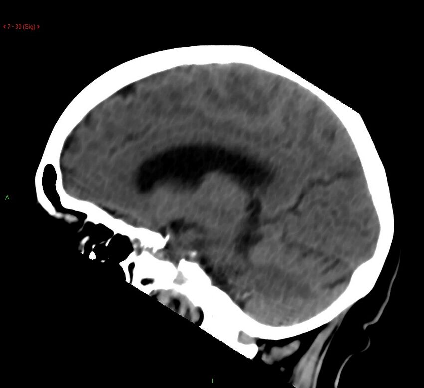 Cerebral amyloid angiopathy-associated lobar intracerebral hemorrhage (Radiopaedia 58378-65518 C 30).jpg