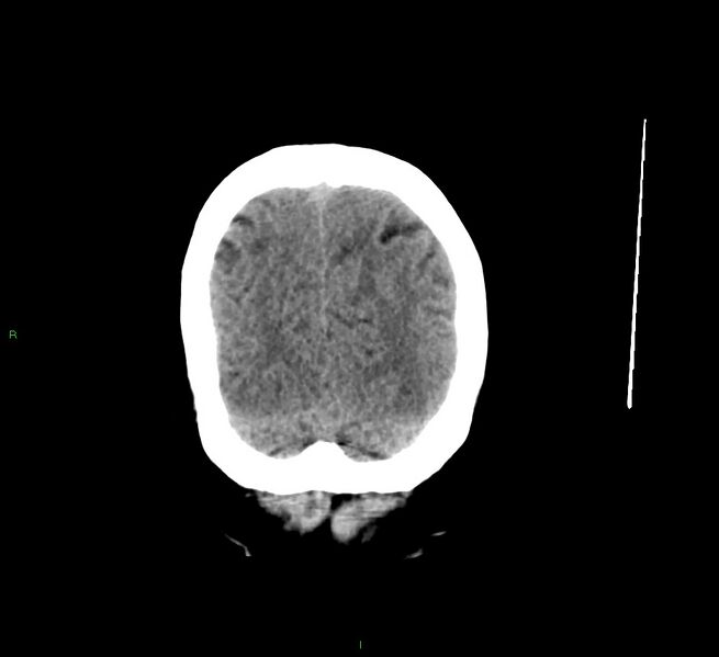 File:Cerebral amyloid angiopathy-associated lobar intracerebral hemorrhage (Radiopaedia 58529-65681 Coronal non-contrast 12).jpg